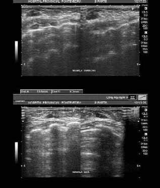 Figura 2. En ambas imágenes ecográficas de las mamilas derecha e izquierda, se aprecia ectasia ductal.